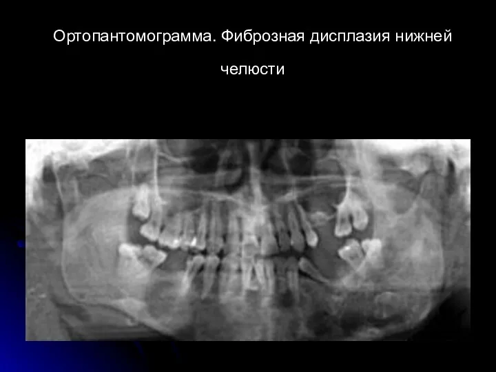Ортопантомограмма. Фиброзная дисплазия нижней челюсти