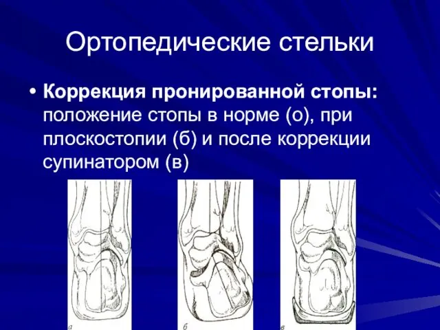 Ортопедические стельки Коррекция пронированной стопы: положение стопы в норме (о), при плоскостопии (б)