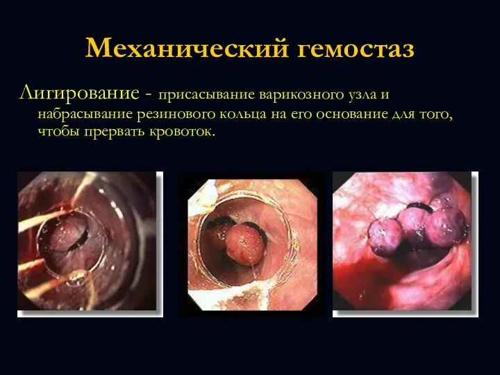 Механический гемостаз Лигирование - присасывание варикозного узла и набрасывание резинового