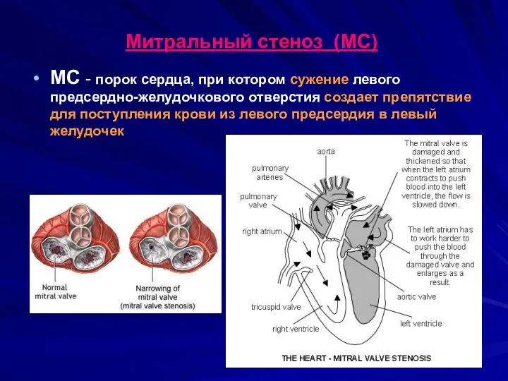 Митральный стеноз (МС) МС - порок сердца, при котором сужение