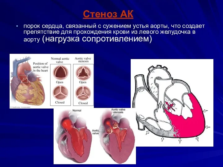 Стеноз АК порок сердца, связанный с сужением устья аорты, что