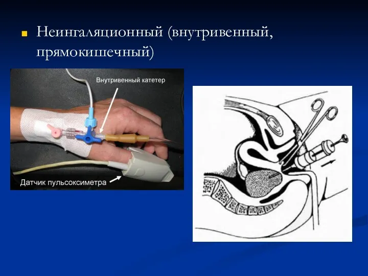 Неингаляционный (внутривенный, прямокишечный)