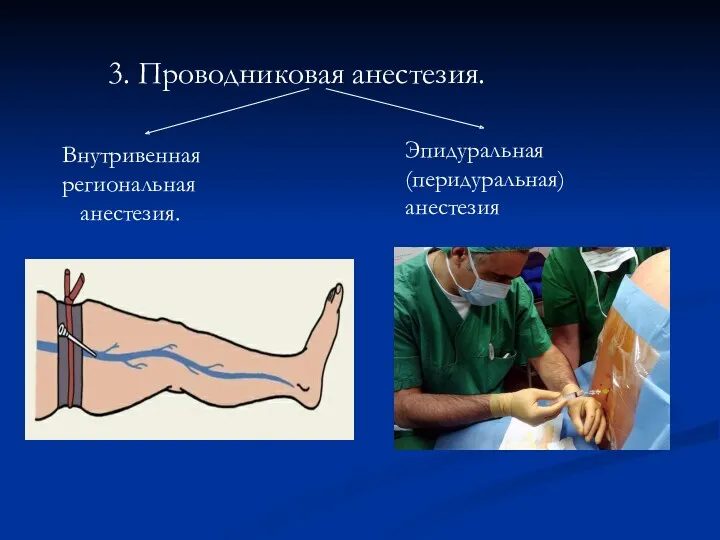 3. Проводниковая анестезия. Внутривенная региональная анестезия. Эпидуральная (перидуральная) анестезия