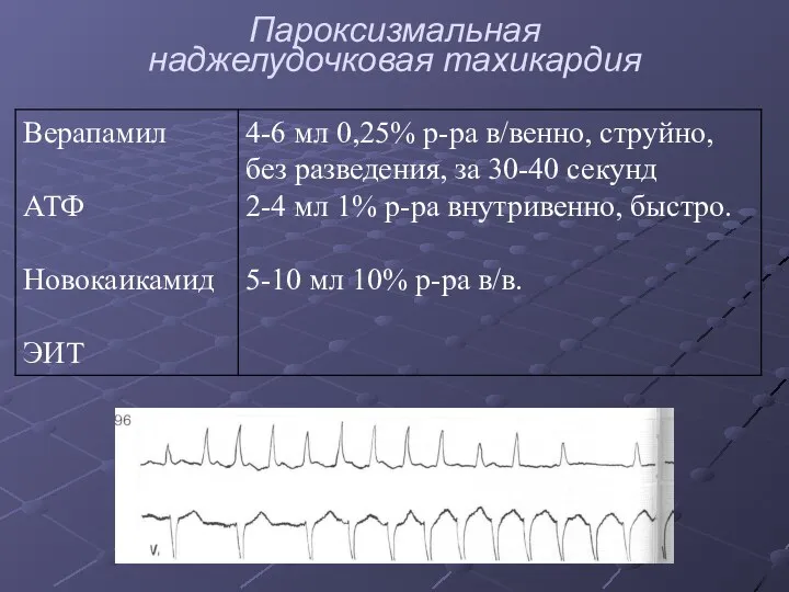 Пароксизмальная наджелудочковая тахикардия