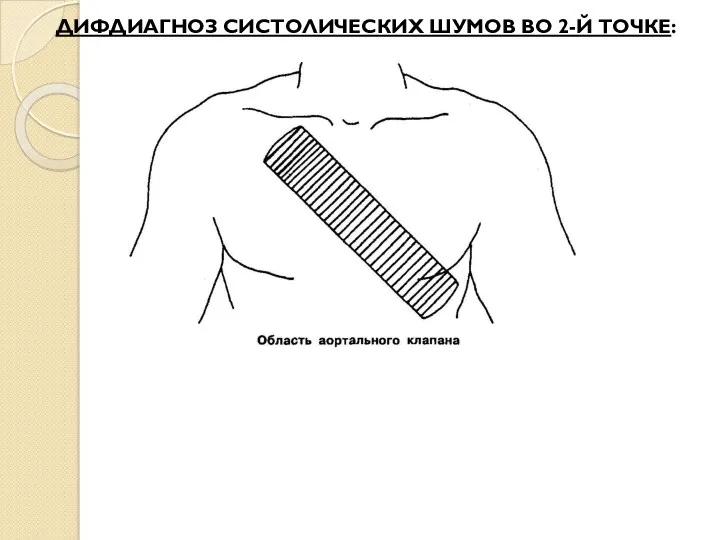 ДИФДИАГНОЗ СИСТОЛИЧЕСКИХ ШУМОВ ВО 2-Й ТОЧКЕ: