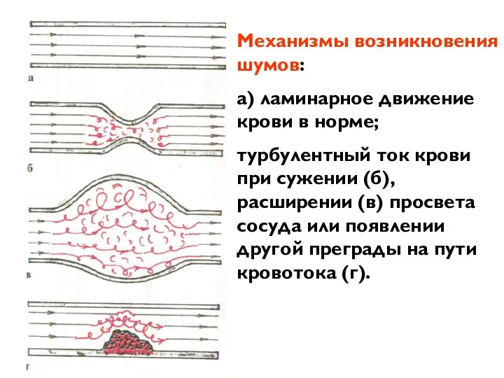 Механизмы возникновения шумов: а) ламинарное движение крови в норме; турбулентный