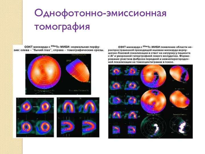 Однофотонно-эмиссионная томография