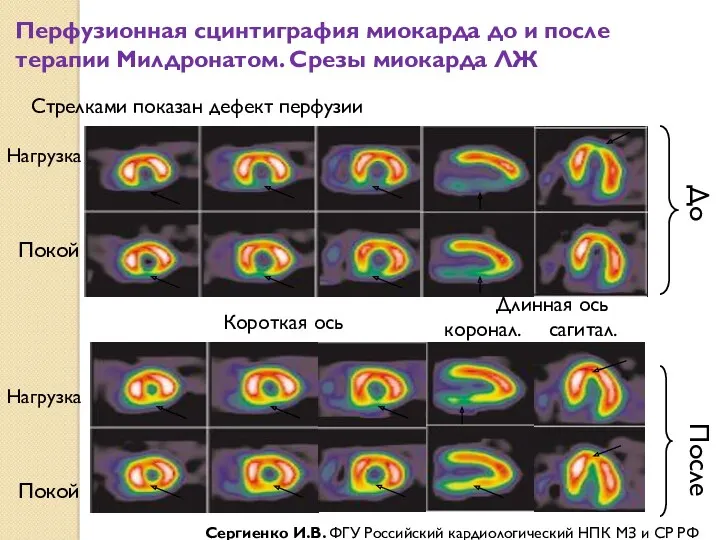 Перфузионная сцинтиграфия миокарда до и после терапии Милдронатом. Срезы миокарда