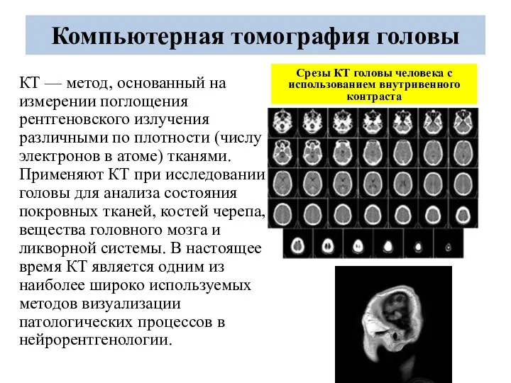 Компьютерная томография головы КТ — метод, основанный на измерении поглощения