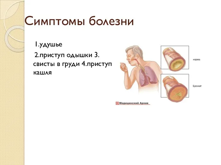 Симптомы болезни 1.удушье 2.приступ одышки 3.свисты в груди 4.приступ кашля