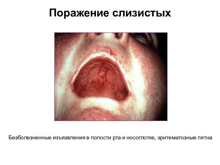 Поражение слизистых Безболезненные изъязвления в полости рта и носоглотке, эритематозные пятна