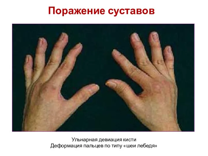 Поражение суставов Ульнарная девиация кисти Деформация пальцев по типу «шеи лебедя»