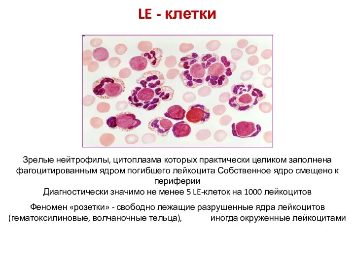 LE - клетки Зрелые нейтрофилы, цитоплазма которых практически целиком заполнена фагоцитированным ядром погибшего