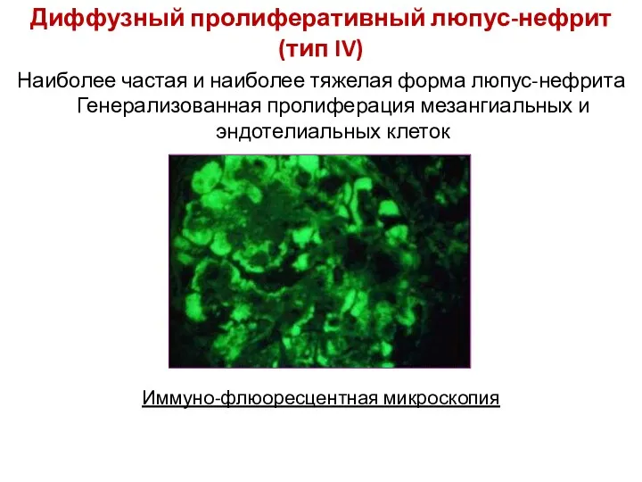 Диффузный пролиферативный люпус-нефрит (тип IV) Наиболее частая и наиболее тяжелая форма люпус-нефрита Генерализованная