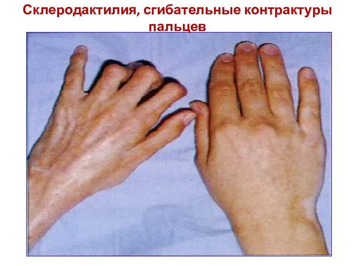 Склеродактилия, сгибательные контрактуры пальцев