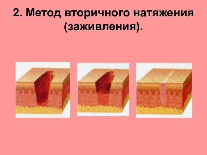 2. Метод вторичного натяжения (заживления).