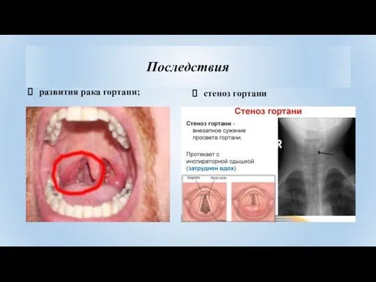 Последствия развития рака гортани; стеноз гортани