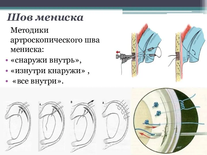 Шов мениска Методики артроскопического шва мениска: «снаружи внутрь», «изнутри кнаружи» , «все внутри».