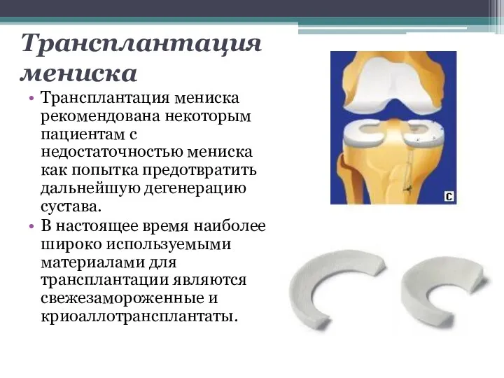 Трансплантация мениска Трансплантация мениска рекомендована некоторым пациентам с недостаточностью мениска