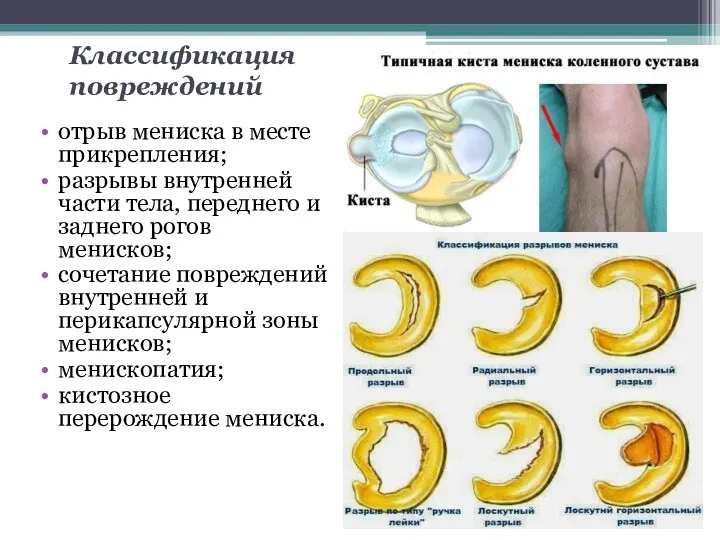 Классификация повреждений отрыв мениска в месте прикрепления; разрывы внутренней части