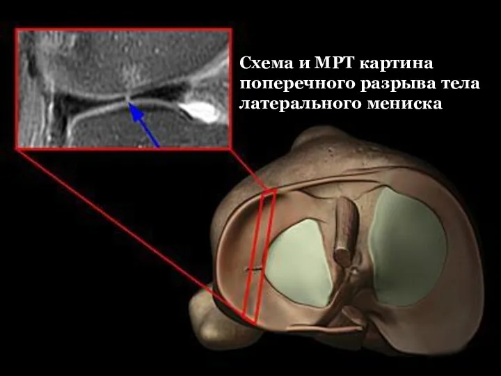 Схема и МРТ картина поперечного разрыва тела латерального мениска