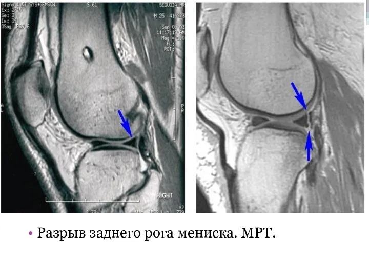 Разрыв заднего рога мениска. МРТ.