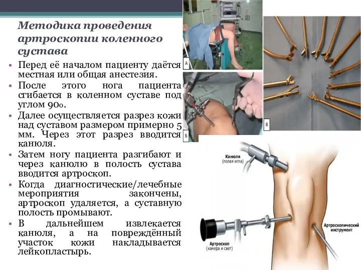 Методика проведения артроскопии коленного сустава Перед её началом пациенту даётся