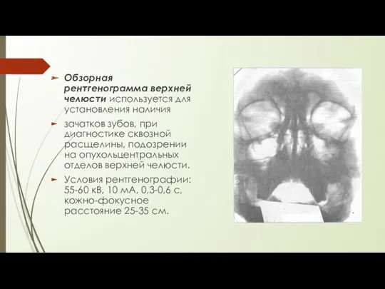 Обзорная рентгенограмма верхней челюсти используется для установления наличия зачатков зубов, при диагностике сквозной
