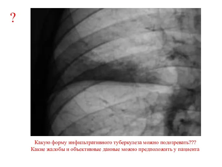 Какую форму инфильтративного туберкулеза можно подозревать??? Какие жалобы и объективные данные можно предположить у пациента ?