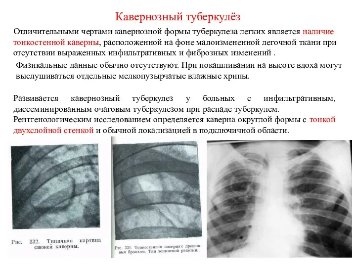 Кавернозный туберкулёз Отличительными чертами кавернозной формы туберкулеза легких является наличие тонкостенной каверны, расположенной