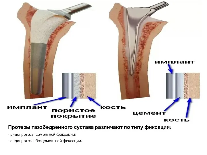 Протезы тазобедренного сустава различают по типу фиксации: - эндопротезы цементной фиксации; - эндопротезы безцементной фиксации.