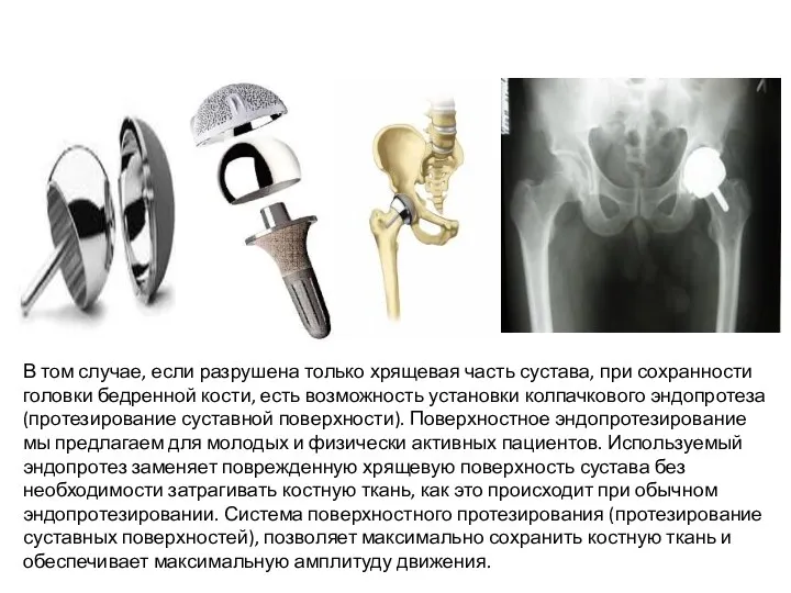 В том случае, если разрушена только хрящевая часть сустава, при