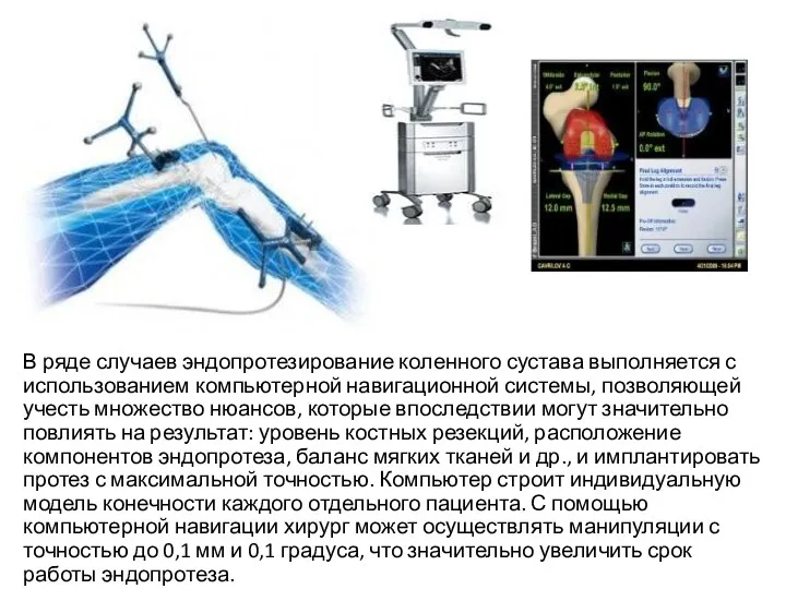 В ряде случаев эндопротезирование коленного сустава выполняется с использованием компьютерной