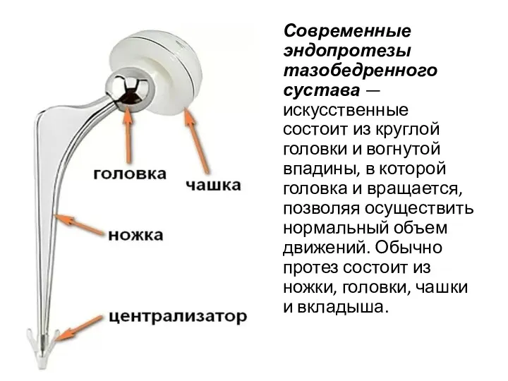 Современные эндопротезы тазобедренного сустава —искусственные состоит из круглой головки и