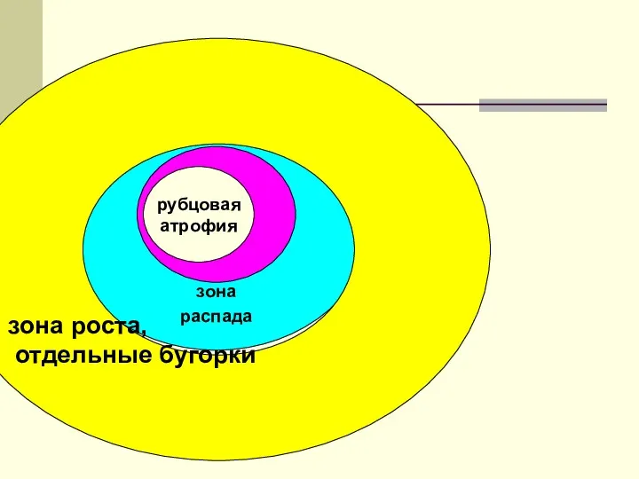 рубцовая атрофия зона распада зона роста, отдельные бугорки