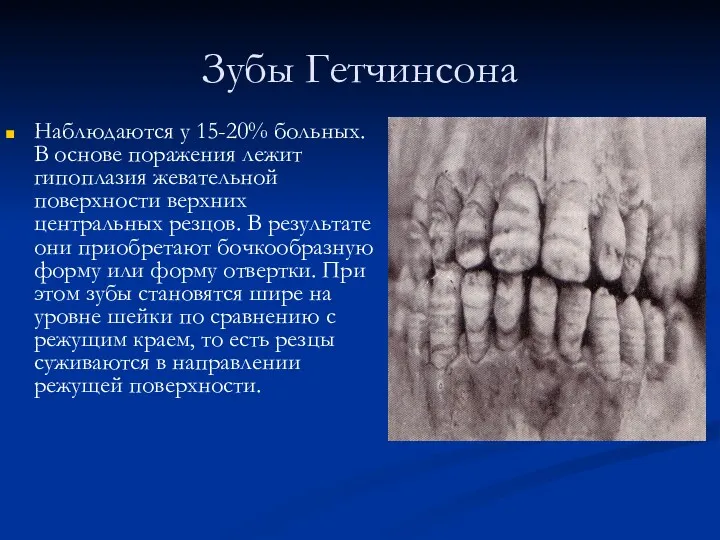 Зубы Гетчинсона Наблюдаются у 15-20% больных. В основе поражения лежит гипоплазия жевательной поверхности