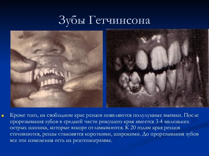 Зубы Гетчинсона Кроме того, на свободном крае резцов появляются полулунные выемки. После прорезывания