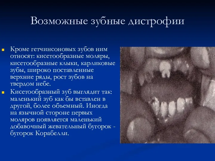 Возможные зубные дистрофии Кроме гетчинсоновых зубов ним относят: кисетообразные моляры, кисетообразные клыки, карликовые