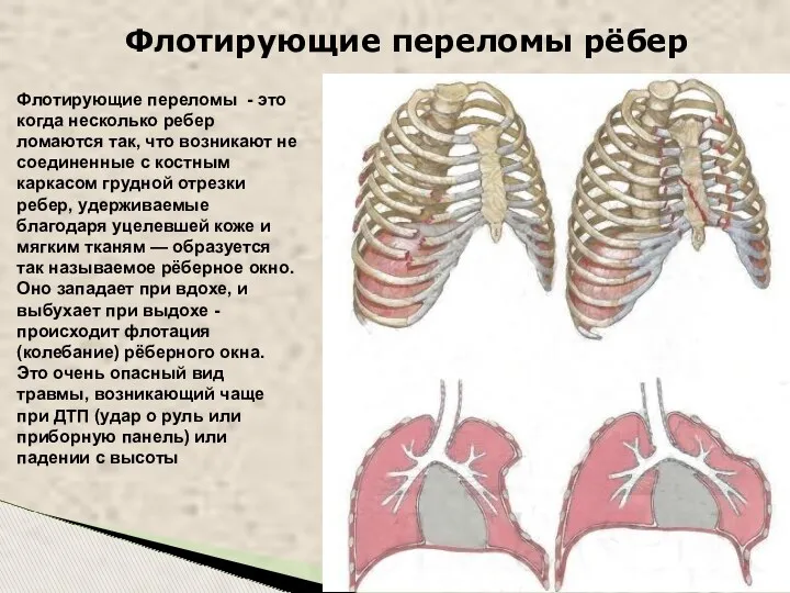 Флотирующие переломы рёбер Флотирующие переломы - это когда несколько ребер