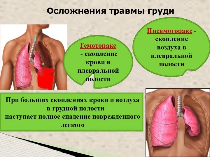 Гемоторакс - скопление крови в плевральной полости Пневмоторакс - скопление