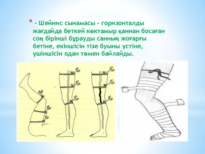 - Шейнис сынамасы – горизонталды жағдайда беткей көктамыр қаннан босаған