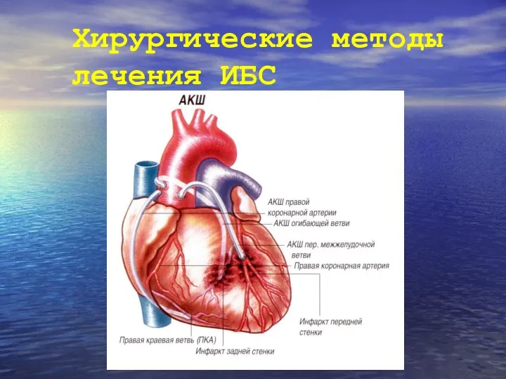 Хирургические методы лечения ИБС