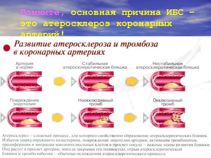 Помните, основная причина ИБС – это атеросклероз коронарных артерий!