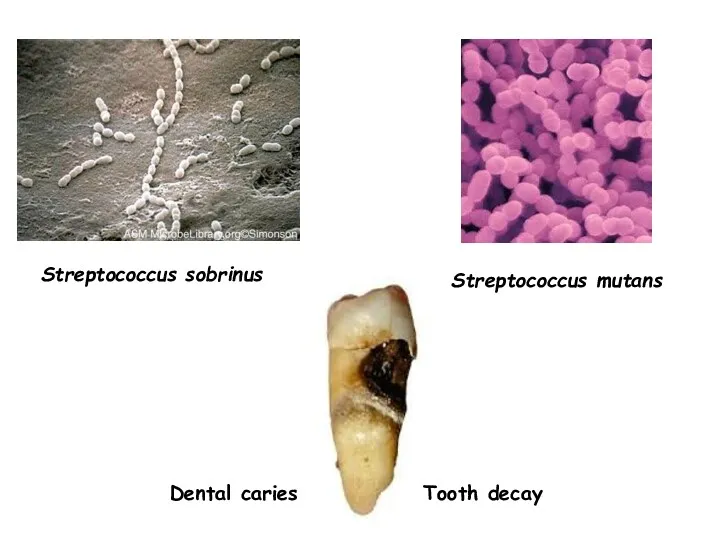 Streptococcus sobrinus Streptococcus mutans Tooth decay Dental caries