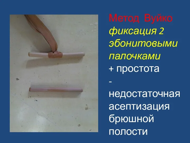 Метод Вуйко фиксация 2 эбонитовыми палочками + простота -недостаточная асептизация брюшной полости
