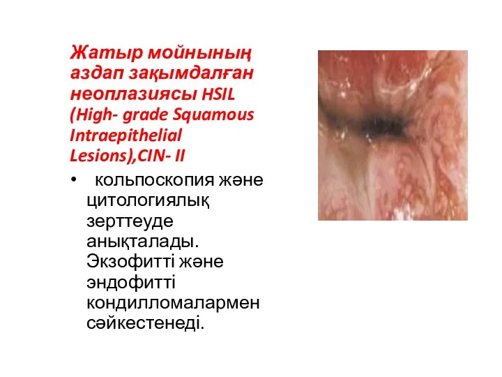 Жатыр мойнының аздап зақымдалған неоплазиясы HSIL (High- grade Squamous Intraepithelial Lesions),CIN- II кольпоскопия