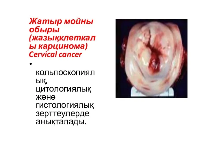 Жатыр мойны обыры (жазықклеткалы карцинома) Cervical cancer кольпоскопиялық, цитологиялық және гистологиялық зерттеулерде анықталады.