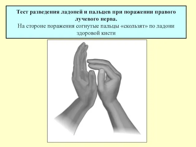 Тест разведения ладоней и пальцев при поражении правого лучевого нерва.