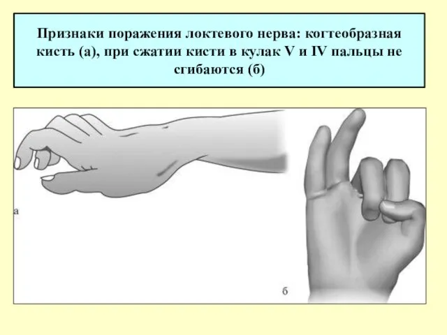 Признаки поражения локтевого нерва: когтеобразная кисть (а), при сжатии кисти