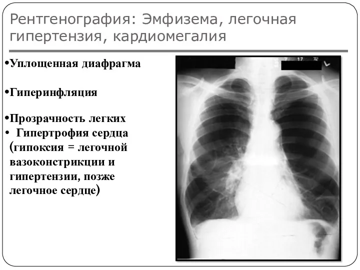 Рентгенография: Эмфизема, легочная гипертензия, кардиомегалия Уплощенная диафрагма Гиперинфляция Прозрачность легких Гипертрофия сердца (гипоксия